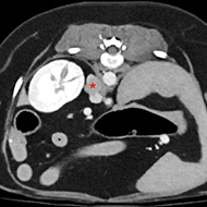 RVC study reveals breed dispositions for rare adrenal tumour